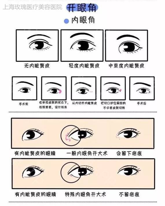 關(guān)于開(kāi)外眼角手術(shù)費(fèi)用，你需要知道的一切，開(kāi)外眼角手術(shù)費(fèi)用全解析