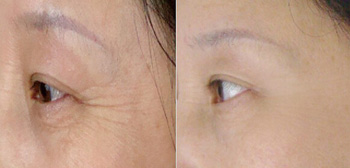 打除皺針一般價(jià)格解析，因素、市場(chǎng)行情及預(yù)算考量，打除皺針的價(jià)格解析，市場(chǎng)行情、影響因素與預(yù)算考量全知道