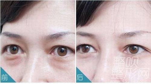 眼袋最好的根治方法，重塑明亮雙眼的秘訣，重塑明亮雙眼，眼袋根治秘訣揭曉