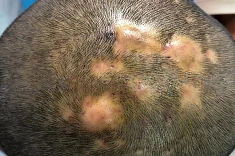 毛囊炎硬疙瘩圖片，了解、識別與治療，毛囊炎硬疙瘩詳解，識別圖片、了解與治療