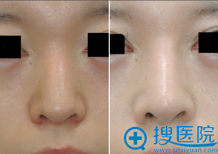 鼻子整容需要多少費(fèi)用，全面解析費(fèi)用因素與影響因素，鼻子整容費(fèi)用全面解析，費(fèi)用因素與影響因素探討