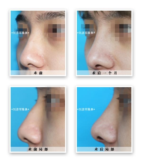 縮鼻頭，改善鼻子外觀的有效方法，縮鼻頭技巧，有效改善鼻子外觀的方法