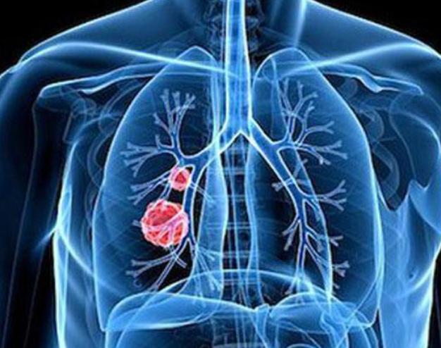 肺部感染恢復(fù)時(shí)間解析，多久能夠康復(fù)？，肺部感染恢復(fù)時(shí)間解析，多久可康復(fù)？