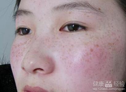 怎樣去除黃褐斑最快最有效，全面解析黃褐斑的成因與有效治療方法，全面解析黃褐斑成因及快速有效的去除方法