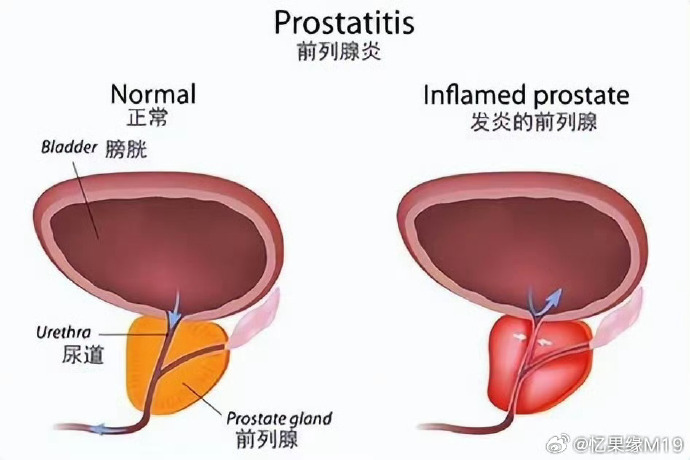 前列腺炎的最佳治療方法探討，前列腺炎最佳治療方法探討與解析