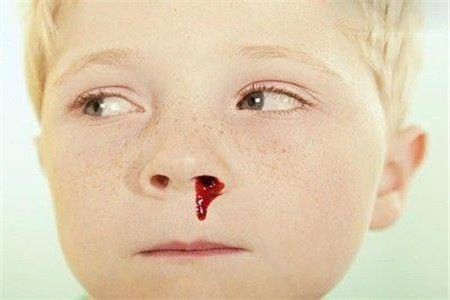 兒童白血病流鼻血的特點及其重要性，兒童白血病流鼻血特征與重要性解析