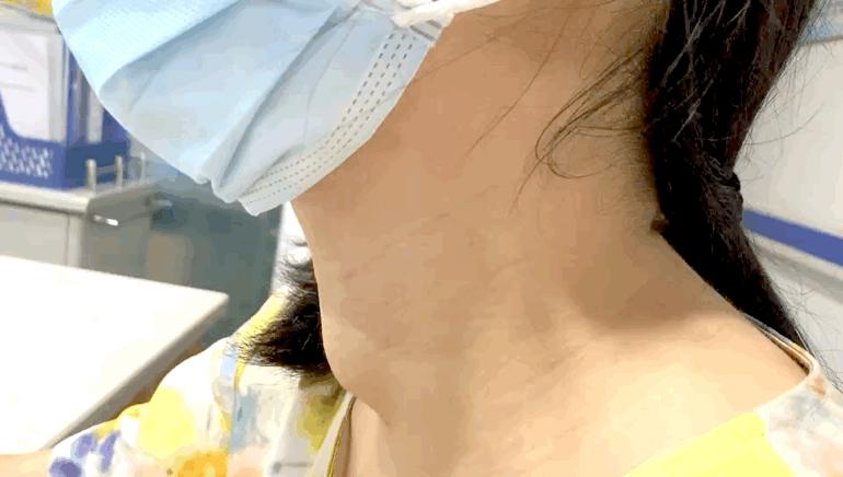 甲狀腺結(jié)節(jié)是被氣的嗎？深入了解甲狀腺結(jié)節(jié)的成因與防治，甲狀腺結(jié)節(jié)成因與防治，情緒因素與疾病關(guān)系探討