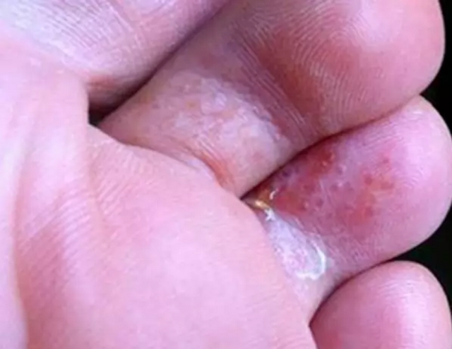 濕疹和腳氣區(qū)別圖，深入了解兩種常見皮膚狀況，濕疹與腳氣區(qū)別詳解，直觀圖表解析兩種常見皮膚狀況