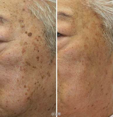 如何有效去除老年斑——全面解析，全面解析，有效去除老年斑的方法