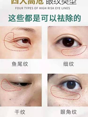 怎樣去除眼角皺紋方法最快，全面解析有效去皺秘訣，快速去除眼角皺紋秘訣，全面解析有效去皺方法