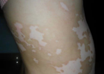 白顛瘋病初期照片癥狀圖片，了解白癜風(fēng)早期表現(xiàn)與防治，白癜風(fēng)初期癥狀圖片解析，了解白癜風(fēng)早期表現(xiàn)與防治攻略