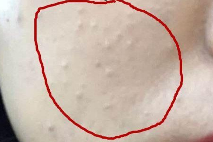 粉刺長什么樣子？圖片解析帶你深入了解，粉刺詳解，圖片解析帶你探索其真實面貌