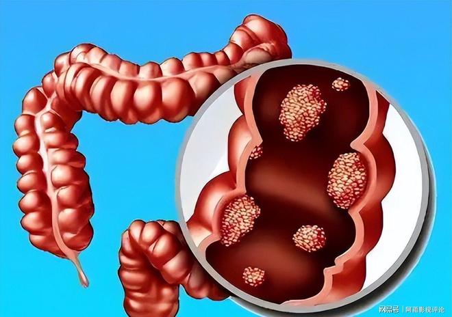 大便形態(tài)變化，細(xì)探腸癌征兆，大便形態(tài)變化揭示腸癌征兆
