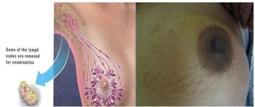 如何排除乳腺癌，自我預(yù)防與早期發(fā)現(xiàn)的重要性，如何預(yù)防與早期發(fā)現(xiàn)乳腺癌，自我檢查與重要性解析