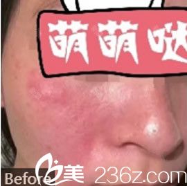 去紅血絲激光手術(shù)費(fèi)用詳解，多少錢？，激光去紅血絲手術(shù)費(fèi)用全面解析，費(fèi)用究竟是多少？