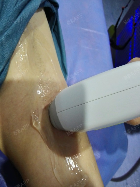 激光脫毛，疼痛感受與體驗(yàn)解析，激光脫毛，疼痛感受與體驗(yàn)詳解