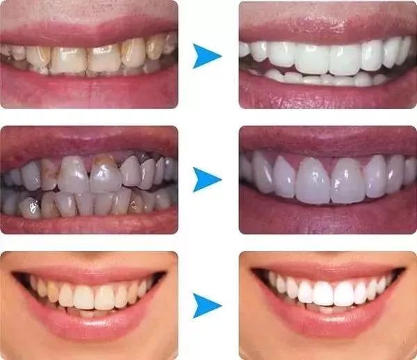 牙齒洗白要多少錢？全面解析牙齒美白費(fèi)用因素，牙齒美白費(fèi)用全解析，牙齒洗白需要多少錢？