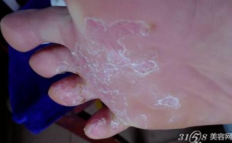 腳脫皮怎么辦？藥物治療推薦與護理建議，腳脫皮解決方法，藥物治療推薦及護理建議