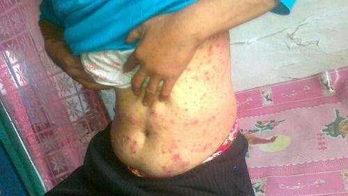 男生下面流膿，原因、應對措施與健康提醒，男性私處流膿，原因、應對與健康警示