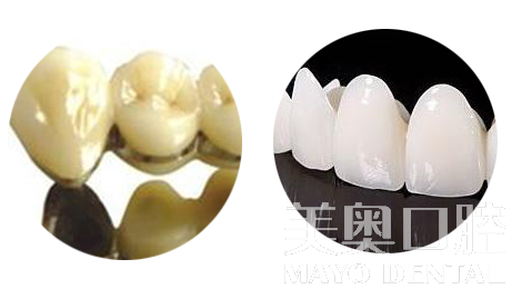 烤瓷牙和全瓷牙的利與弊，深度解析，深度解析，烤瓷牙與全瓷牙的優(yōu)缺點(diǎn)對(duì)比