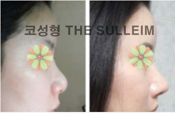 如何縮小鼻翼不手術(shù)，實(shí)用方法與建議，不手術(shù)縮小鼻翼的實(shí)用方法與建議