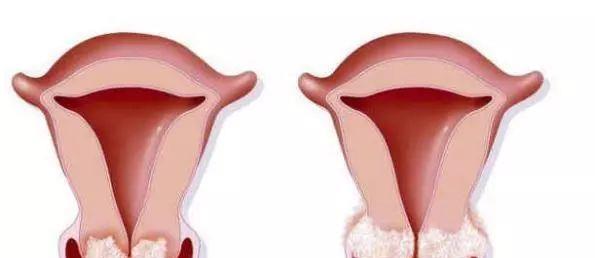 女性HPV初期感染的圖片及其相關(guān)知識(shí)科普，女性HPV初期感染圖片與知識(shí)科普，了解、預(yù)防與治療