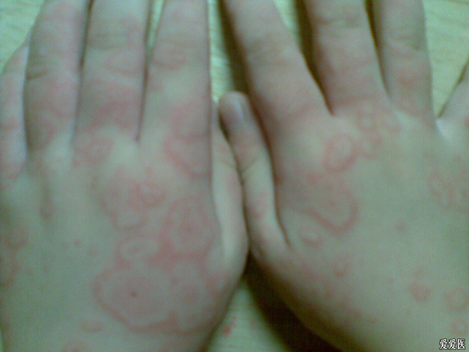 關于螨蟲過敏圖片與澳彩資料的查詢，來自94848.cσm的詳盡資源，螨蟲過敏圖片與澳彩資料查詢，詳盡資源來自94848.cσm