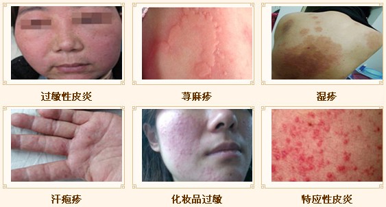 過敏性皮炎治愈方法，全面解析與應(yīng)對策略，過敏性皮炎全面解析，治愈方法與應(yīng)對策略