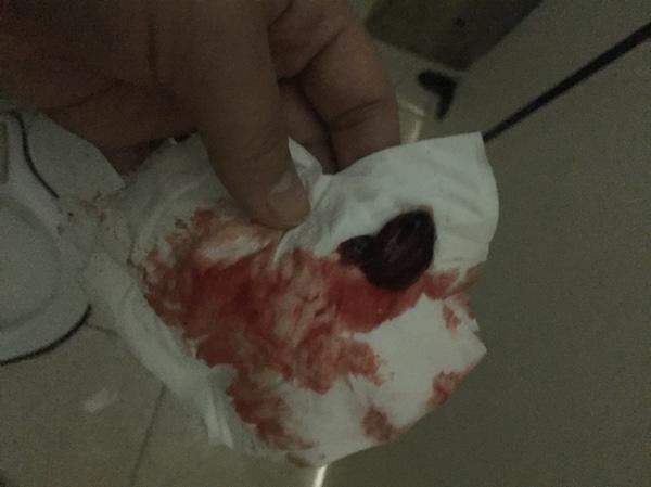 自然流產(chǎn)后的清宮問題解析——自己流掉了需要清宮嗎？，自然流產(chǎn)后需清宮嗎？——深度解析清宮問題疑慮！