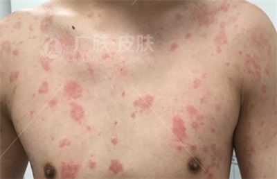 晚上發(fā)作的蕁麻疹名稱及其相關(guān)知識解析，夜間蕁麻疹發(fā)作解析，癥狀、原因與知識科普