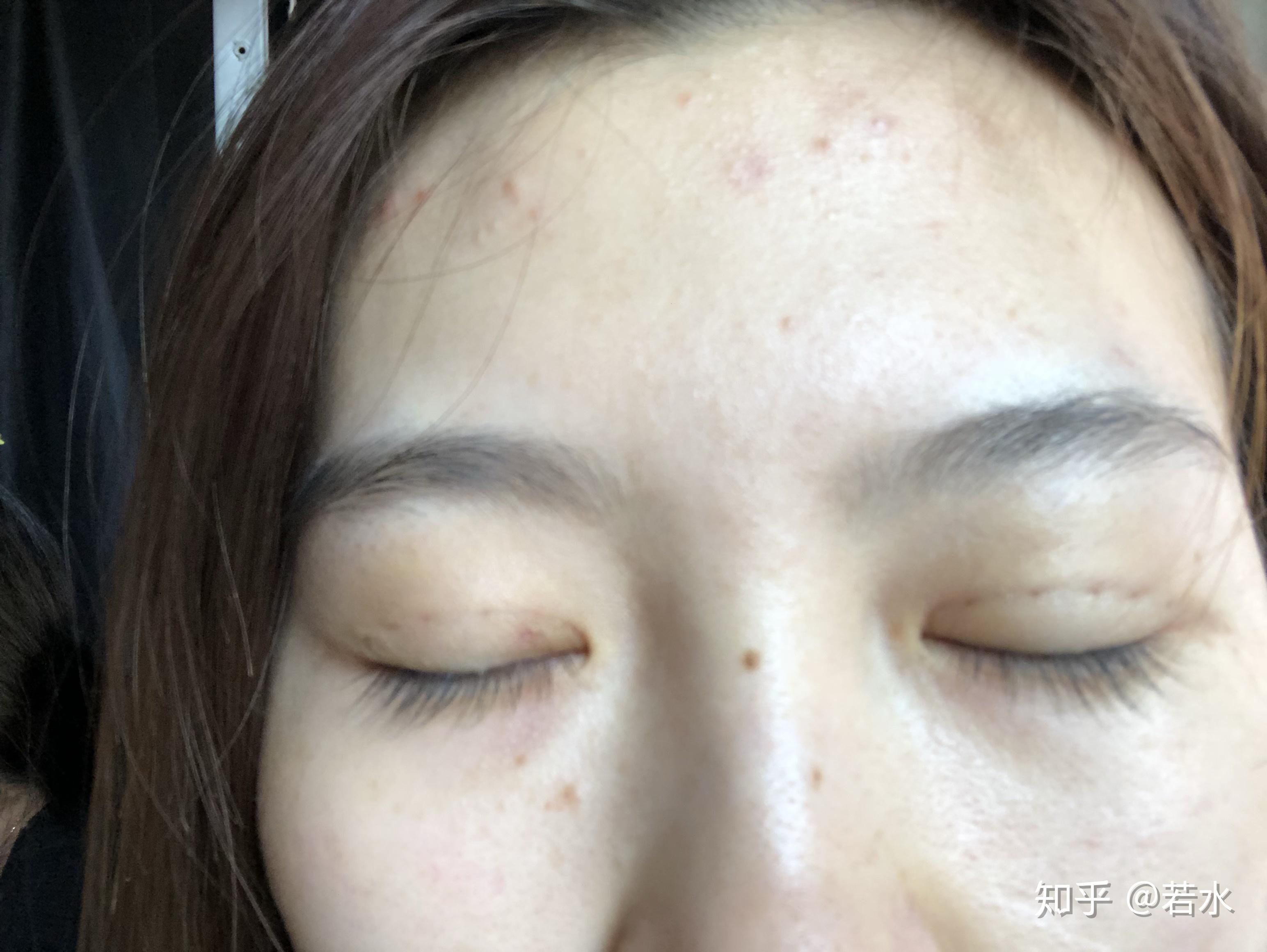 雙眼皮埋線(xiàn)手術(shù)效果持久性解析，持續(xù)時(shí)間與影響因素探討，雙眼皮埋線(xiàn)手術(shù)的持久性與影響因素深度解析