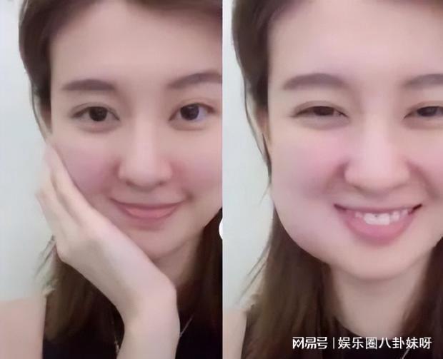 智齒被肉包住了一定要拔嗎？解讀智齒包埋現(xiàn)象及其處理方式，解讀智齒包埋現(xiàn)象，智齒被肉包住是否需要拔除？