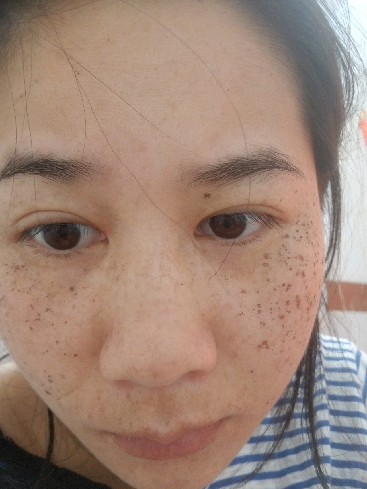 激光祛斑后的15天，見證肌膚煥變的瞬間，激光祛斑后15天，肌膚煥新瞬間見證