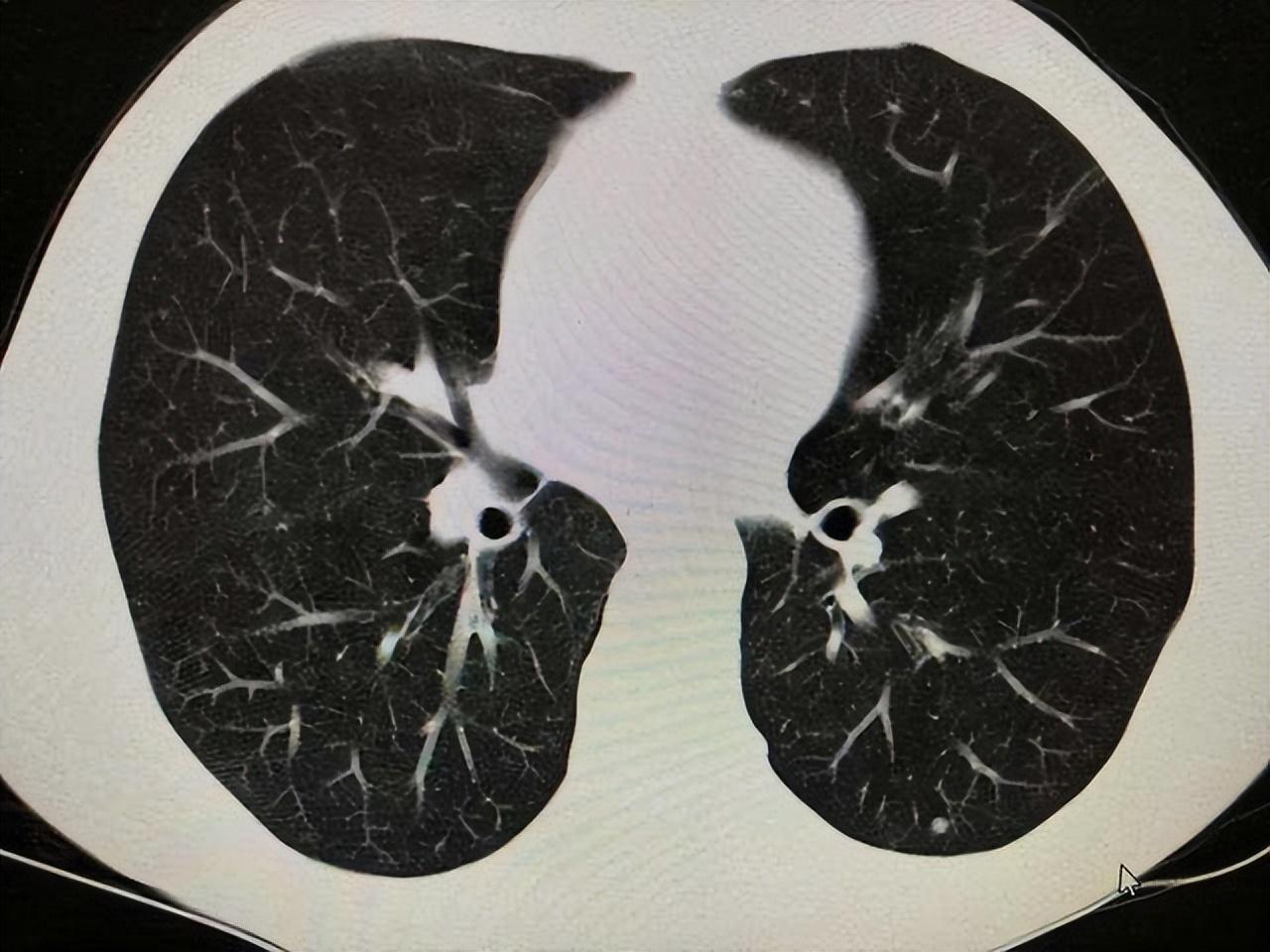 關(guān)于打科興后出現(xiàn)肺結(jié)節(jié)的探討，科興疫苗接種與肺結(jié)節(jié)關(guān)系探討