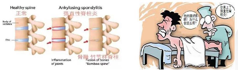 強(qiáng)直性脊柱炎的早期癥狀是什么？深入了解與應(yīng)對，強(qiáng)直性脊柱炎早期癥狀解析，深入了解與應(yīng)對策略