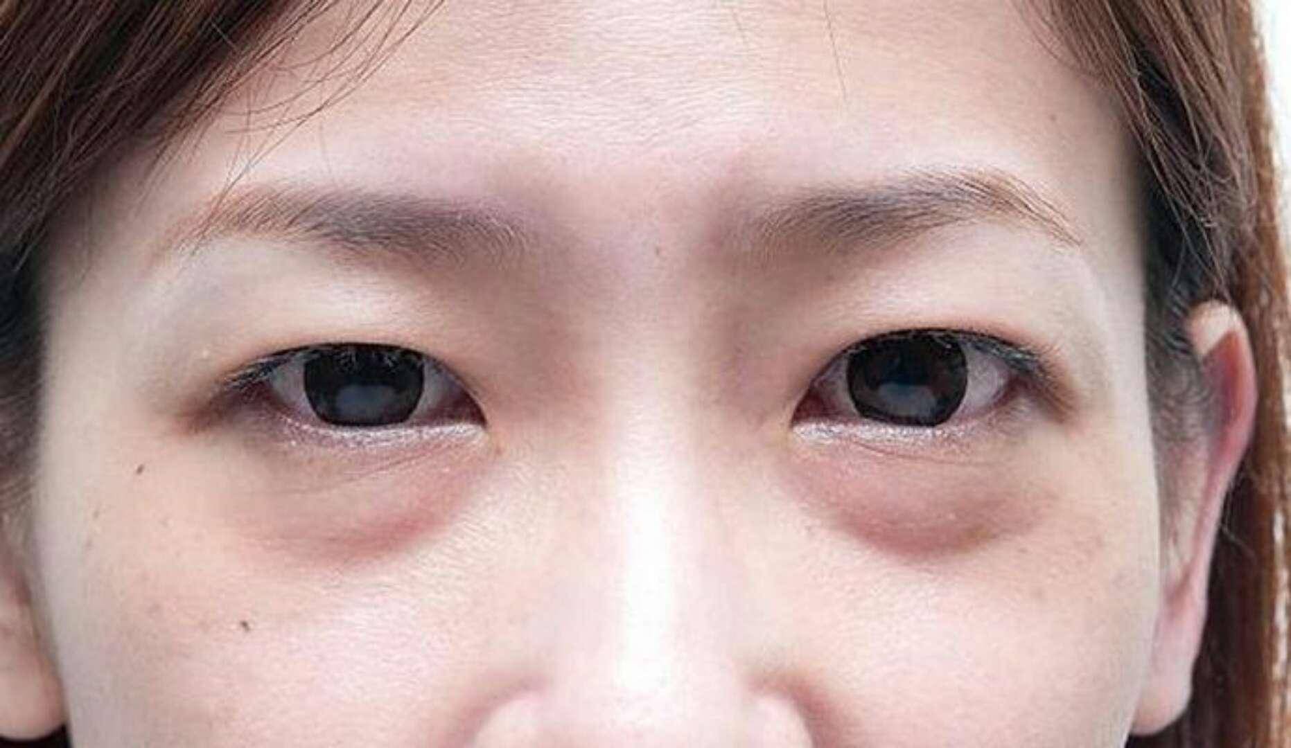 割眼袋，了解、準(zhǔn)備與恢復(fù)的全流程指南，割眼袋全程指南，從了解、準(zhǔn)備到恢復(fù)全攻略