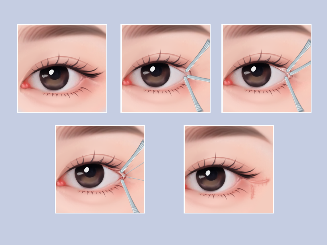 如何讓眼睛變大——全方位指南，全方位指南，讓眼睛變大的秘訣與方法