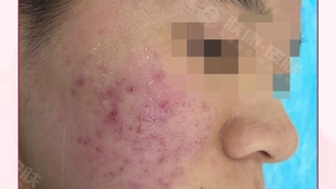 治療痤瘡的費用分析，了解花費多少以及背后的因素，治療痤瘡的費用詳解，了解花費背后的因素