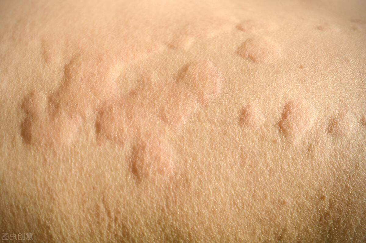 熱性蕁麻疹，成因、癥狀與應(yīng)對(duì)策略，熱性蕁麻疹，成因、癥狀及應(yīng)對(duì)之策