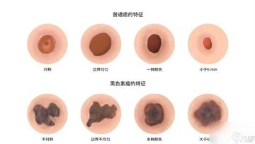正常痣與黑色素瘤圖片，了解二者的區(qū)別與識(shí)別方法，正常痣與黑色素瘤圖片對(duì)比，區(qū)分與識(shí)別方法指南