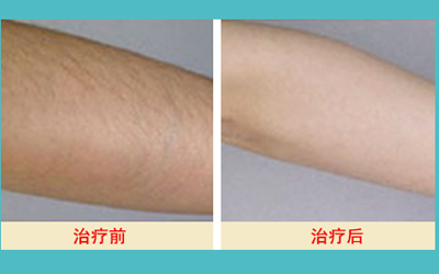 激光脫毛的價格解析，多少錢才能擁有絲滑肌膚？，激光脫毛價格詳解，多少錢能擁有絲滑肌膚？