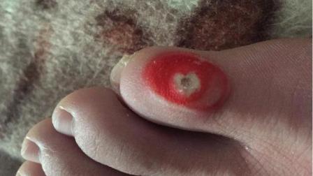 10分鐘治雞眼土方法——簡(jiǎn)單有效的自然療法，簡(jiǎn)單自然療法，10分鐘土方法治愈雞眼