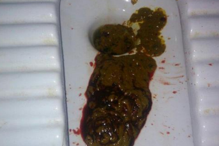 拉屎拉出鮮紅的血不痛，原因分析及應(yīng)對措施，無痛性鮮紅便血原因解析與應(yīng)對方案