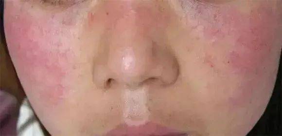 臉過敏發(fā)紅癢怎么辦——臉部過敏急救指南，臉部過敏發(fā)紅癢怎么辦？急救指南助你快速緩解不適！