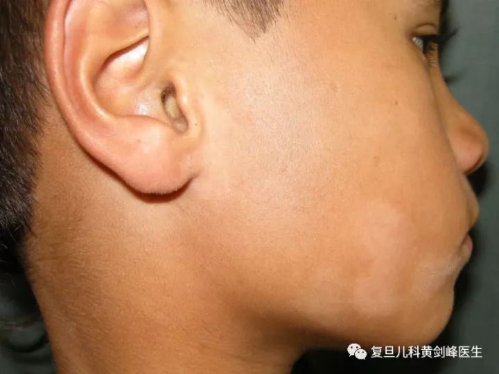 白色糠疹，了解、預(yù)防與治療，白色糠疹，全面解析、預(yù)防與治療方法