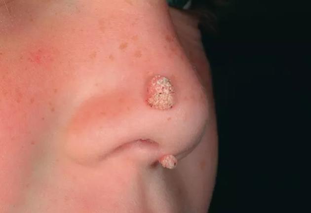 如何判斷是否為雞眼——全面解析雞眼癥狀與診斷方法，雞眼癥狀詳解，診斷方法與判斷指南