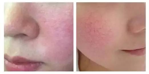 臉頰紅血絲如何修復(fù)，全面解析與實用建議，臉頰紅血絲全面解析與修復(fù)實用建議